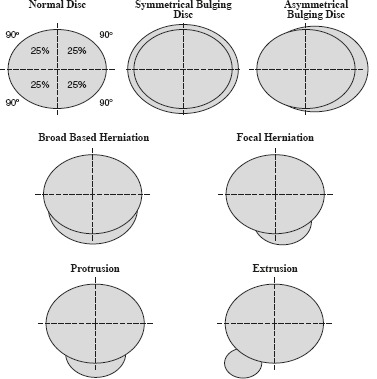 Schematic diagram showing types of lumbar disc herniation including protrusion, extrusion, and sequestration