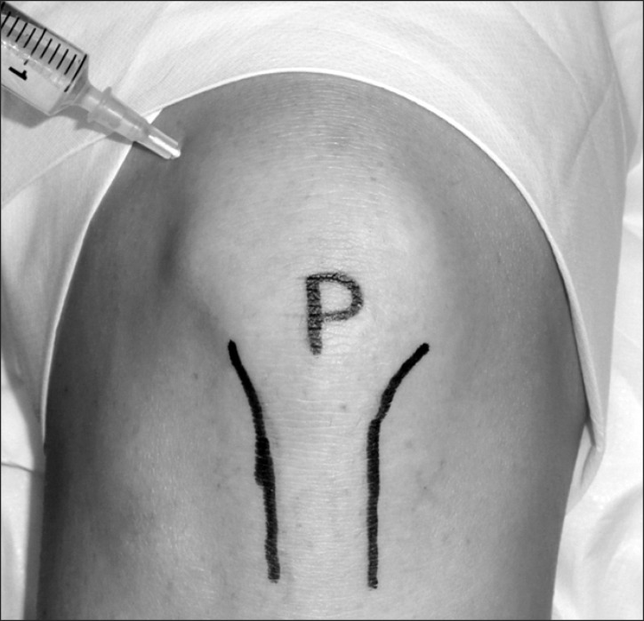 Photograph of right knee demonstrating the superolateral approach to knee joint injection via the suprapatellar bursa