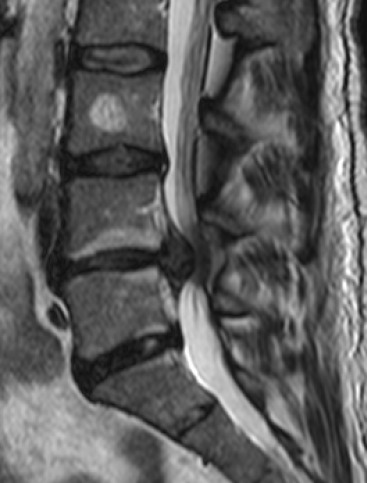 Sagittal T2-weighted MRI showing central disc herniation at L4-L5 with compression of the thecal sac