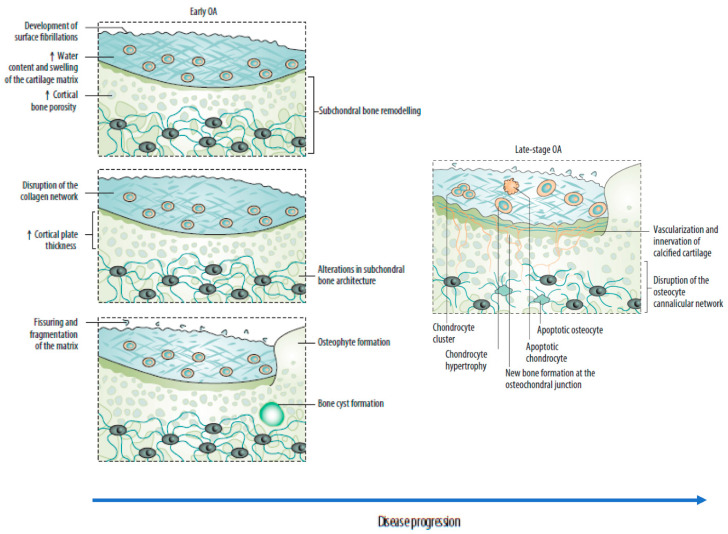 Diagram showing sequential changes in the osteochondral unit during osteoarthritis progression from early to late stage