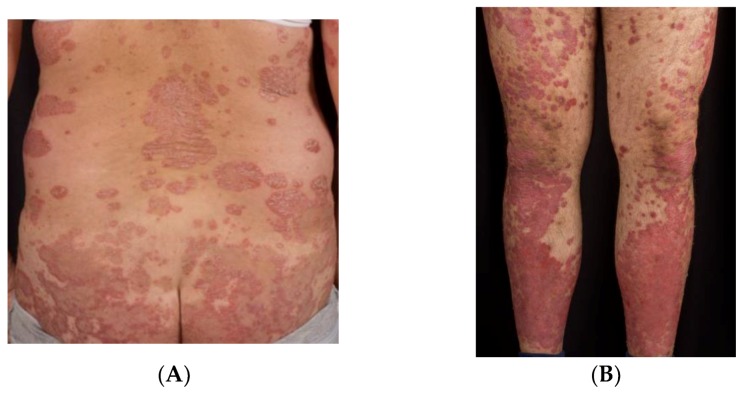 Clinical photographs showing erythematous scaly plaques characteristic of psoriasis vulgaris on various body sites