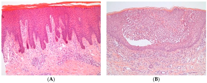 Histopathological features of psoriasis showing acanthosis, parakeratosis, and inflammatory infiltrates