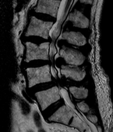 Sagittal MRI of lumbar spine showing spinal canal stenosis with narrowing at multiple levels