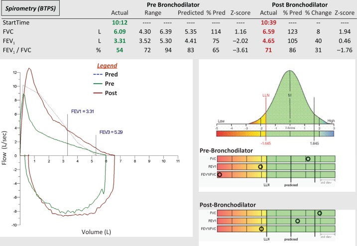 Spirometry showing significant bronchodilator response with overlaid pre- and post-bronchodilator flow-volume loops