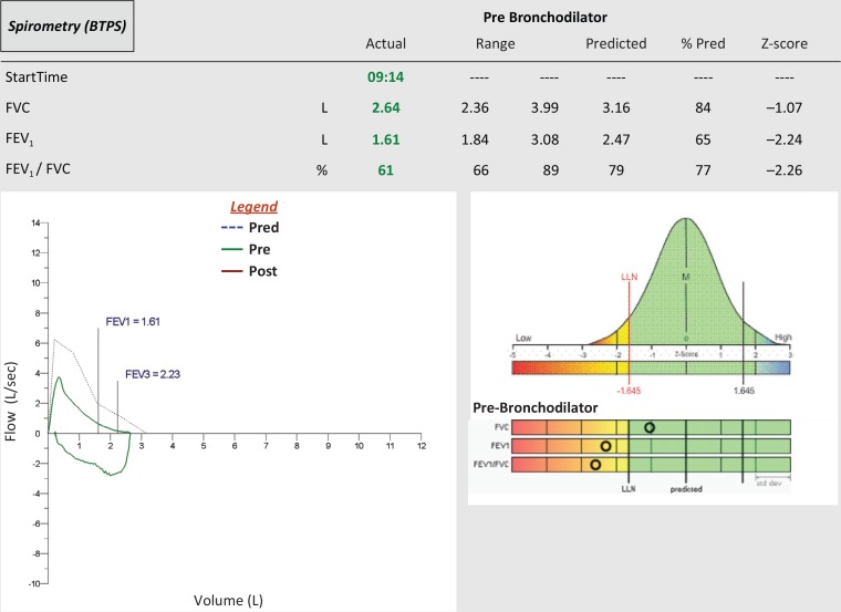 Spirometry flow-volume loop showing obstructive pattern with reduced FEV1/FVC ratio and concave expiratory curve