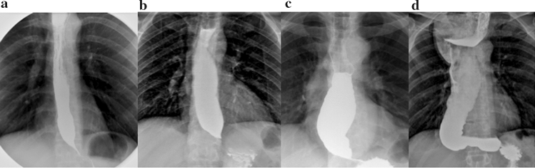 Barium swallow images showing progressive esophageal dilation and bird-beak appearance at the GEJ across disease stages