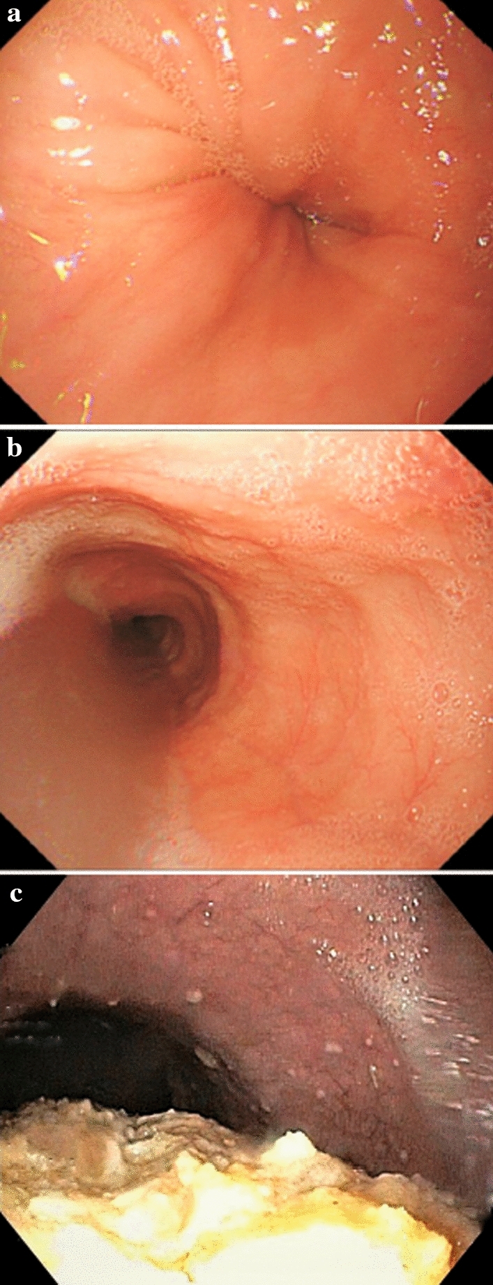 Endoscopic findings showing dilated esophagus with retained food and a closed lower esophageal sphincter