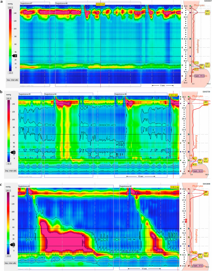 High-resolution manometry tracings showing the three subtypes of achalasia with characteristic pressure patterns