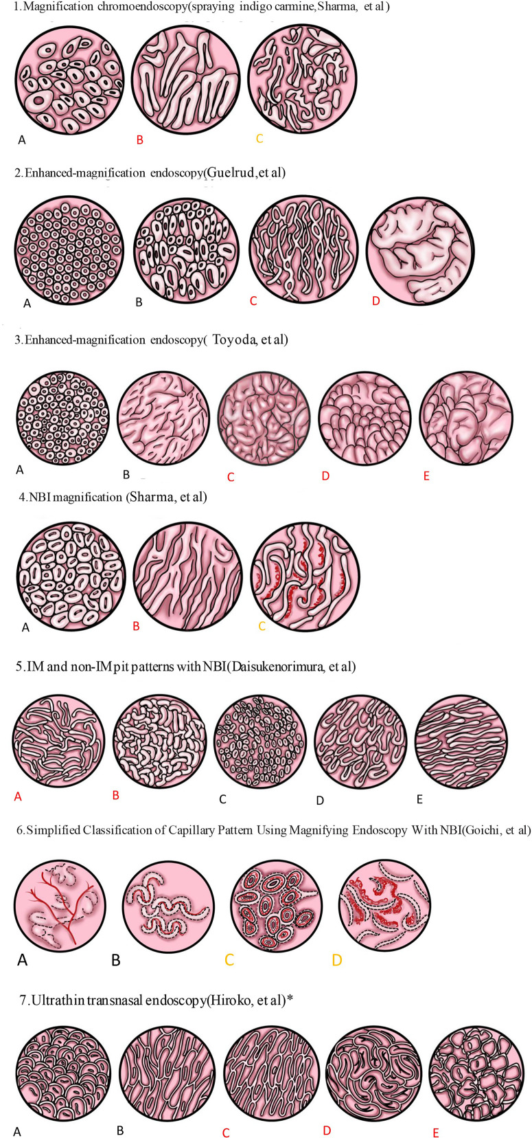Endoscopic examination techniques for Barrett esophagus including narrow-band imaging and indigo carmine staining