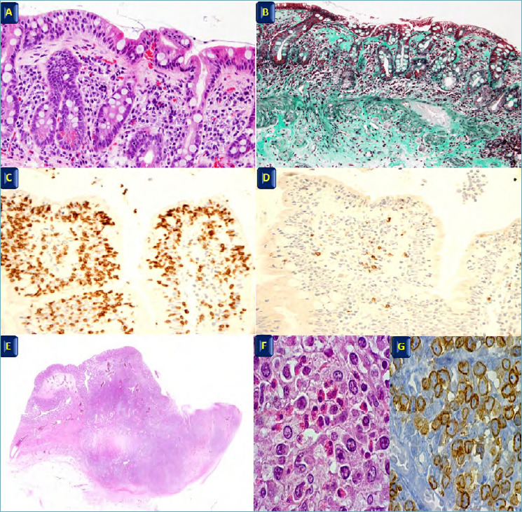 Histopathology of celiac complications including collagenous sprue, refractory celiac disease, and enteropathy-associated T-cell lymphoma