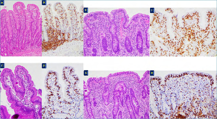 Histopathology of celiac disease showing progression from normal mucosa through intraepithelial lymphocytosis to villous atrophy with Marsh classification