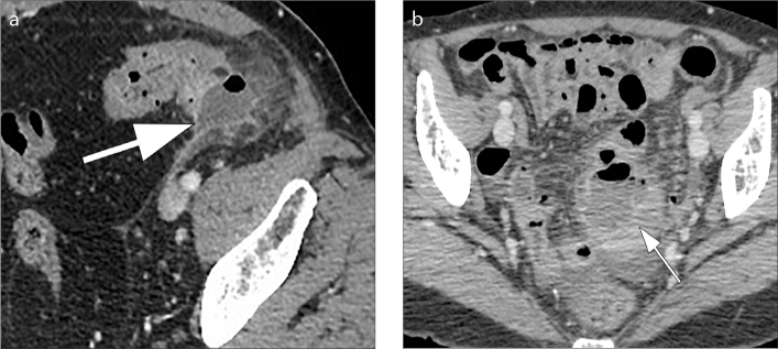 CT image of diverticular abscess showing heterogeneous collection with contrast-enhancing wall