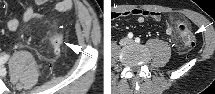 CT images showing wall thickening of the left colon with pericolonic fat stranding in acute diverticulitis