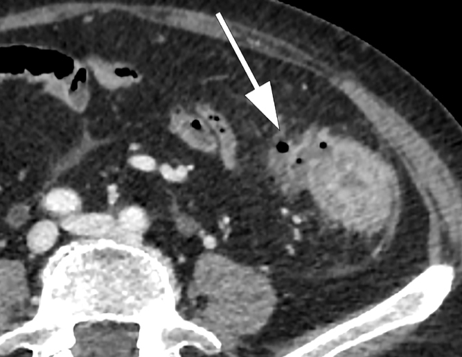 CT image showing microperforation in diverticulitis with extraluminal air pockets and pericolic fat density changes