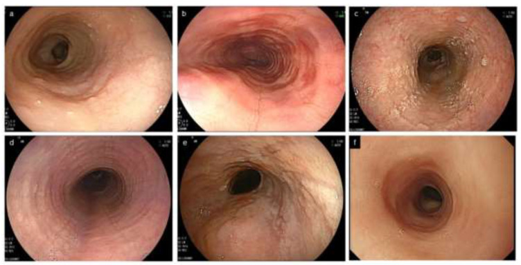 Characteristic endoscopic findings of eosinophilic esophagitis including rings, furrows, white exudates, and strictures