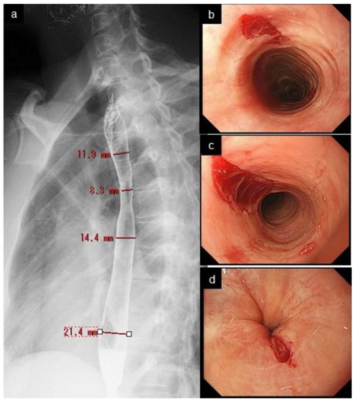 Narrow-caliber esophagus and crepe-paper mucosa in eosinophilic esophagitis