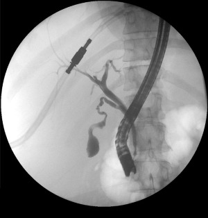 Normal ERCP cholangiogram showing the biliary tree with common bile duct, hepatic ducts, and intrahepatic branches