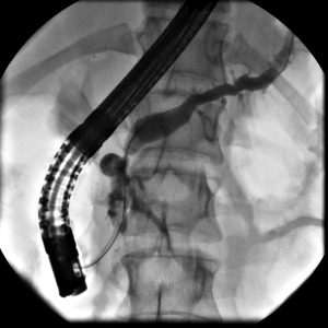 ERCP pancreatogram showing chronic pancreatitis with dilated irregular main pancreatic duct and intraductal stones