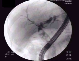 ERCP cholangiogram showing multiple filling defects within a dilated common bile duct representing choledocholithiasis
