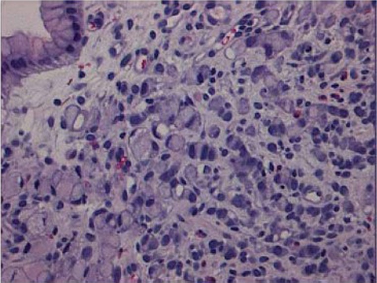 Histopathology of signet ring cell carcinoma showing diffuse-type gastric cancer cells in the lamina propria