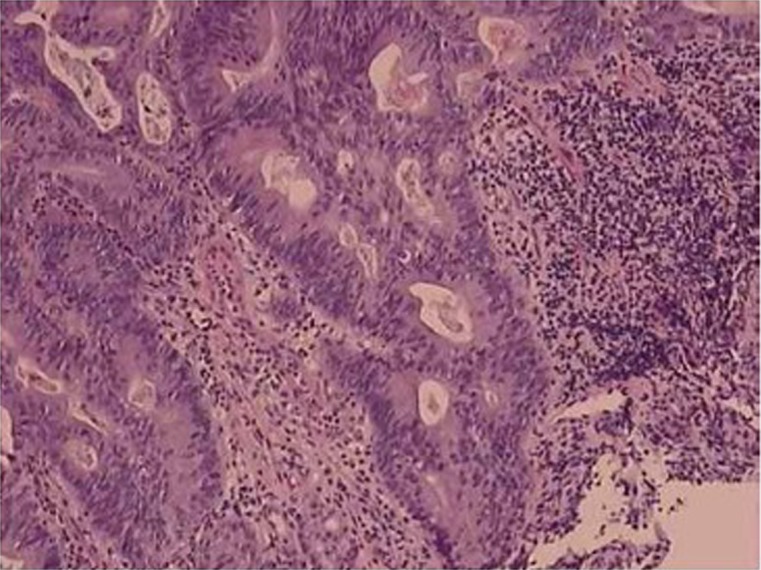 Histopathology of tubular adenocarcinoma showing well-formed neoplastic glands characteristic of intestinal-type gastric cancer