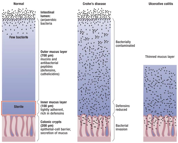 Diagram comparing the mucosal barrier in health, Crohn disease, and ulcerative colitis showing transmural vs mucosal inflammation