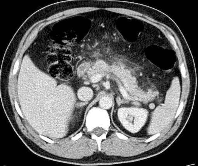 CT image of mild pancreatitis showing peripancreatic fat stranding with preserved pancreatic enhancement