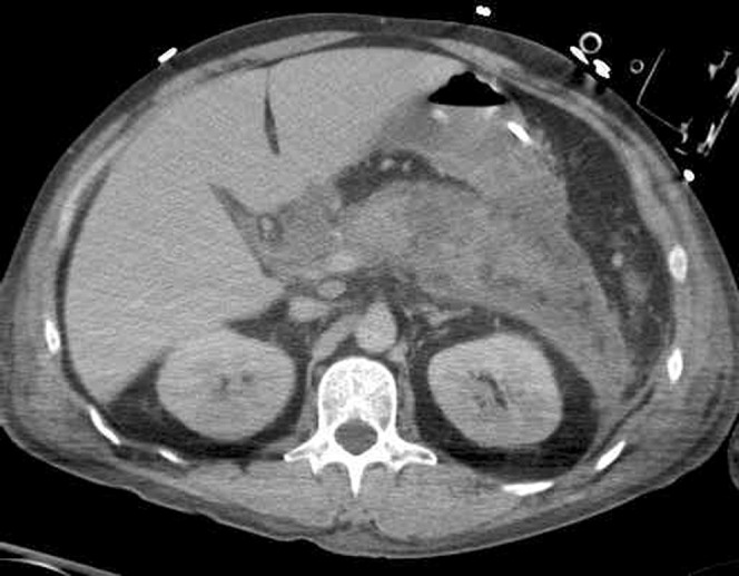 CT image showing areas of non-enhancement of the pancreas indicating necrosis with Grey Turner sign
