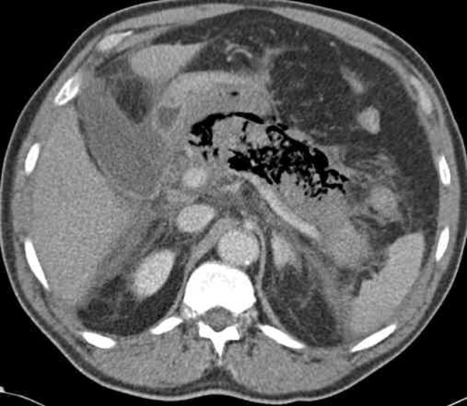 CT image showing infected pancreatic necrosis with gas locules within the necrotic collection