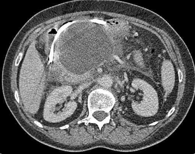 CT image showing a large pancreatic pseudocyst displacing and compressing the stomach anteriorly