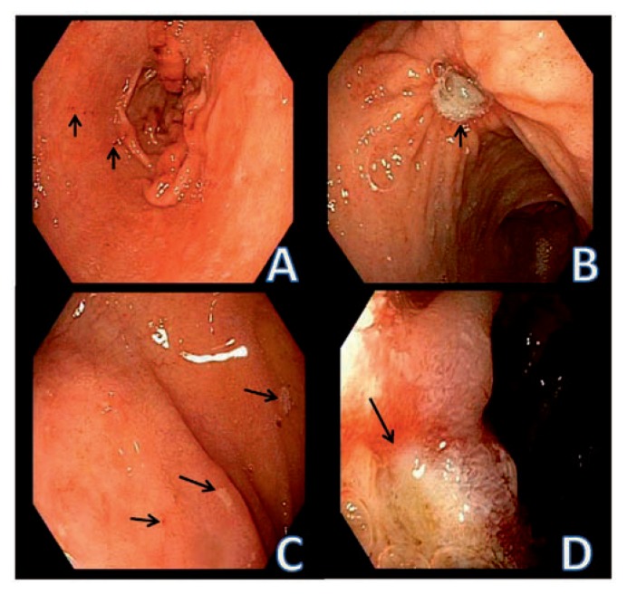 Endoscopic images of peptic erosions and ulcers in the stomach and duodenum showing mucosal breaks, hemorrhage, and ulcer depth