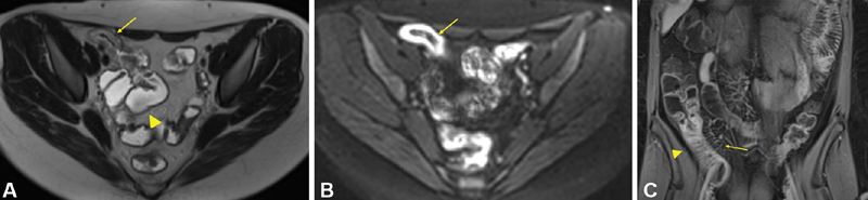 MR enterography showing Crohn ileitis with mural hyperenhancement, wall thickening, stricture, and upstream dilation