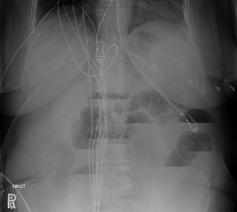 Upright abdominal X-ray showing multiple air-fluid levels in dilated small bowel loops consistent with small bowel obstruction