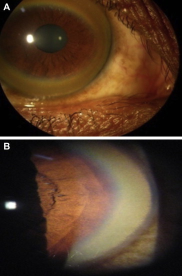 Kayser-Fleischer ring showing golden-brown copper deposits in the corneal periphery on naked eye and slit-lamp examination