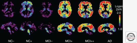 PiB PET amyloid imaging showing range of amyloid-beta deposition across normal controls, mild cognitive impairment, and Alzheimer disease patients
