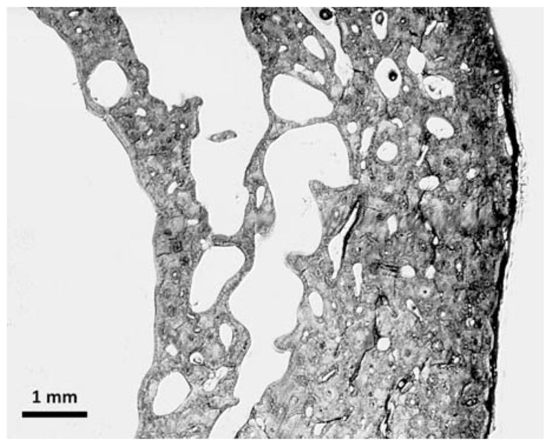 Light microscopy image showing cortical bone trabecularization at the endocortical surface in osteoporotic bone from a 91-year-old female