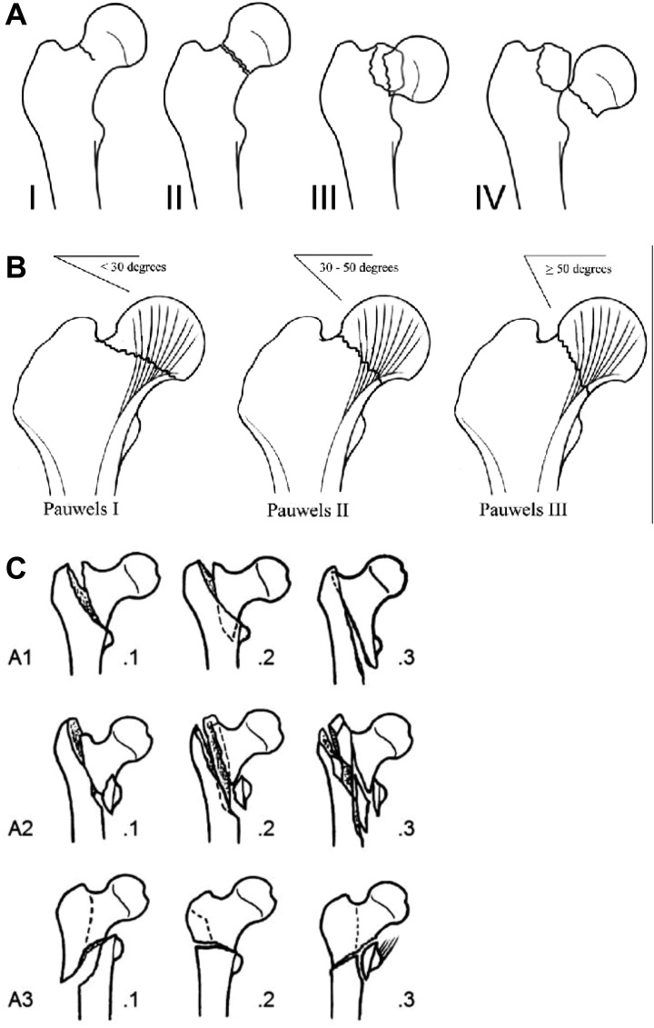 Hip fracture classification systems showing Garden classification for femoral neck fractures, Pauwels classification based on fracture angle, and AO/OTA classification