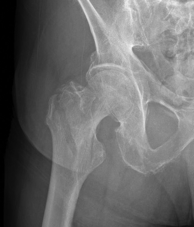 Radiographic classification of intertrochanteric hip fractures showing stable and unstable fracture patterns with treatment considerations