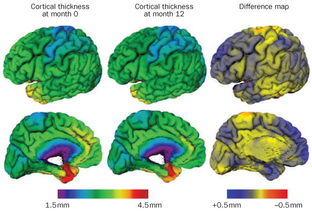 Brain mapping of cortical thinning in patients with mild cognitive impairment, showing regions of significant atrophy compared to controls
