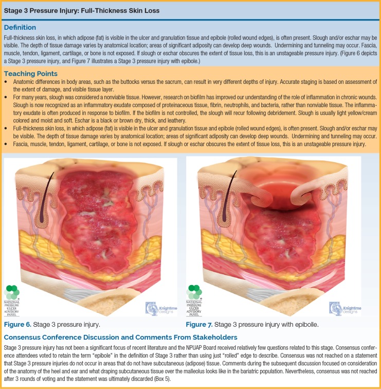 Clinical photograph and cross-sectional diagram of Stage 4 pressure injury showing full-thickness tissue loss with exposed bone, tendon, or muscle