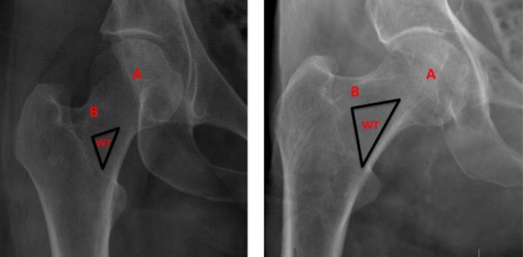 Anatomical diagram of the proximal femur showing the Ward triangle and trabecular degeneration patterns relevant to hip fracture risk