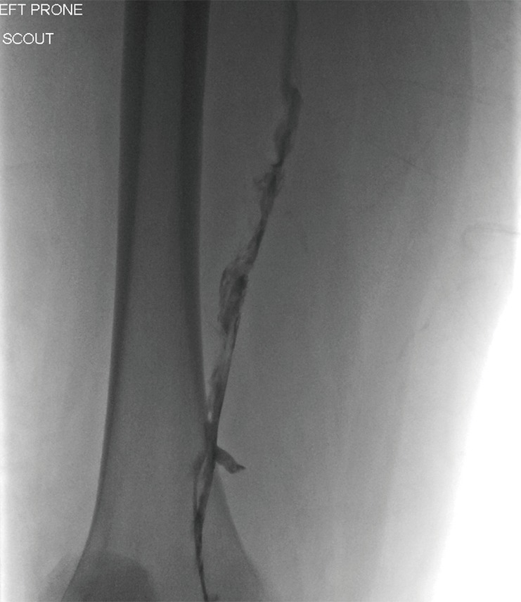 Contrast venography showing deep vein thrombosis filling defect