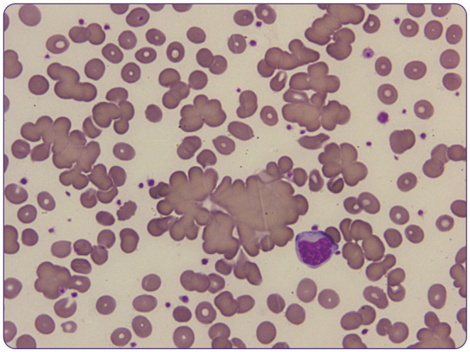 Peripheral blood smear showing cold agglutinin disease with red blood cell agglutination