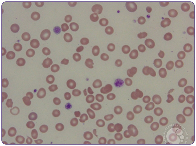 Peripheral blood smear showing schistocytes in microangiopathic hemolytic anemia