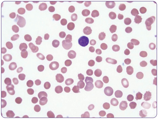 Peripheral blood smear showing spherocytes in hereditary spherocytosis