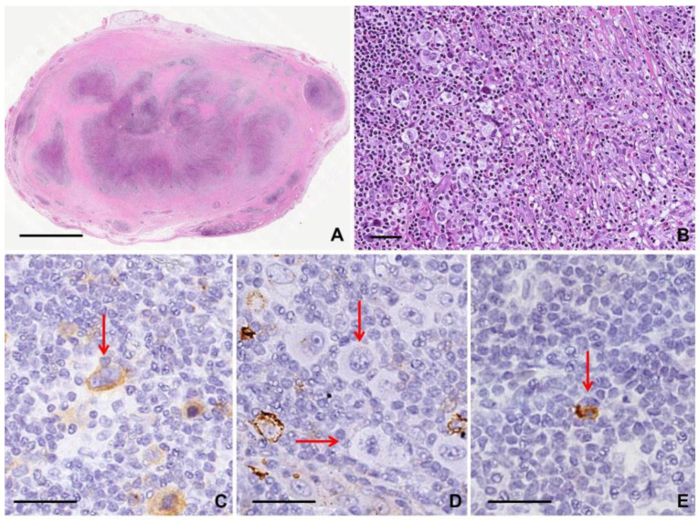 Reed-Sternberg cells in classic Hodgkin lymphoma histopathology