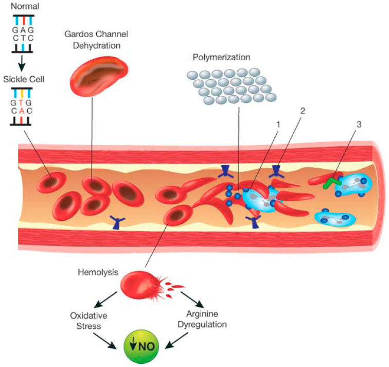 Genetic basis and pathophysiology of acute myeloid leukemia blast proliferation