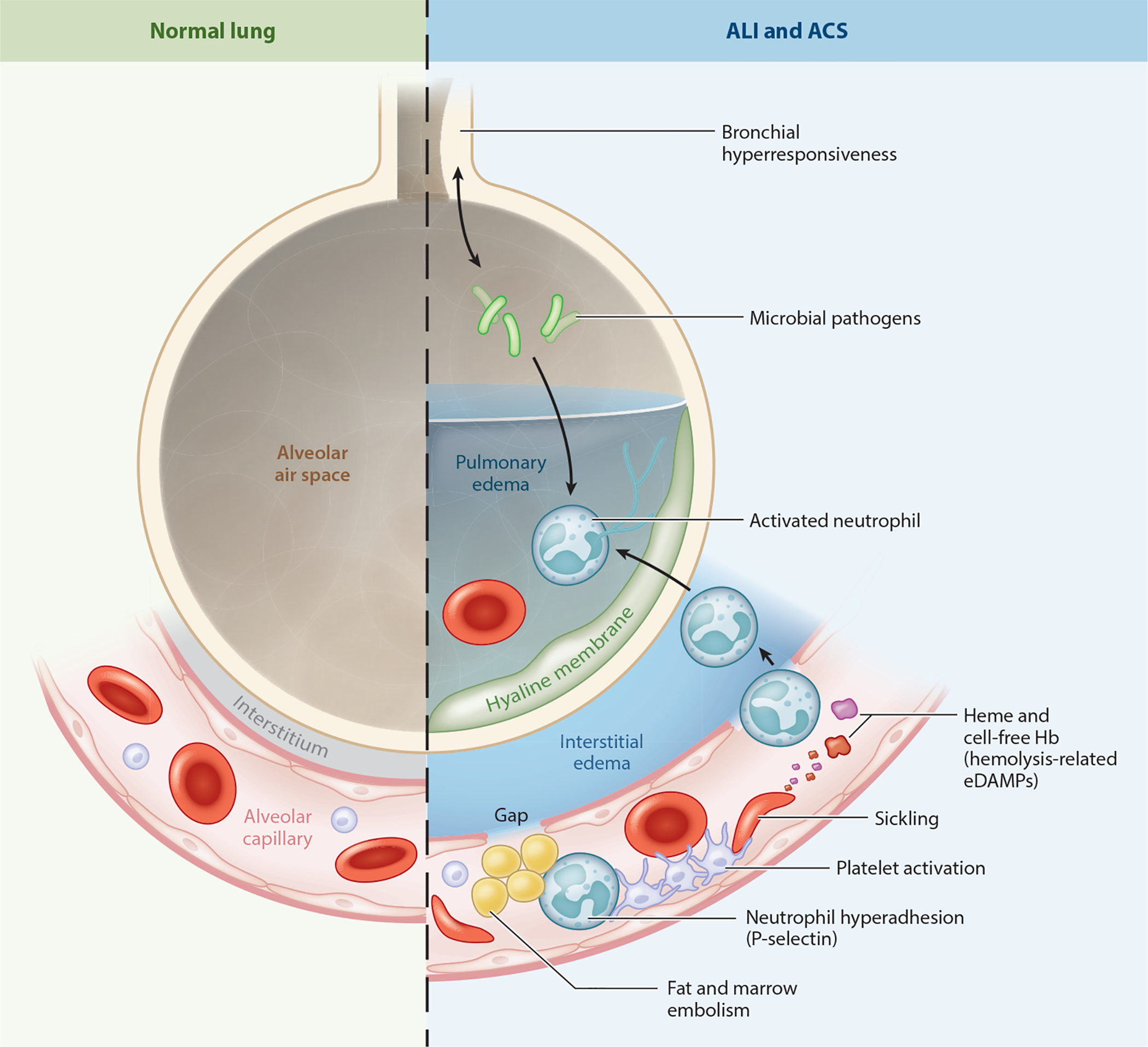 Pathways of acute lung injury including fat embolism, inflammation, and vascular damage