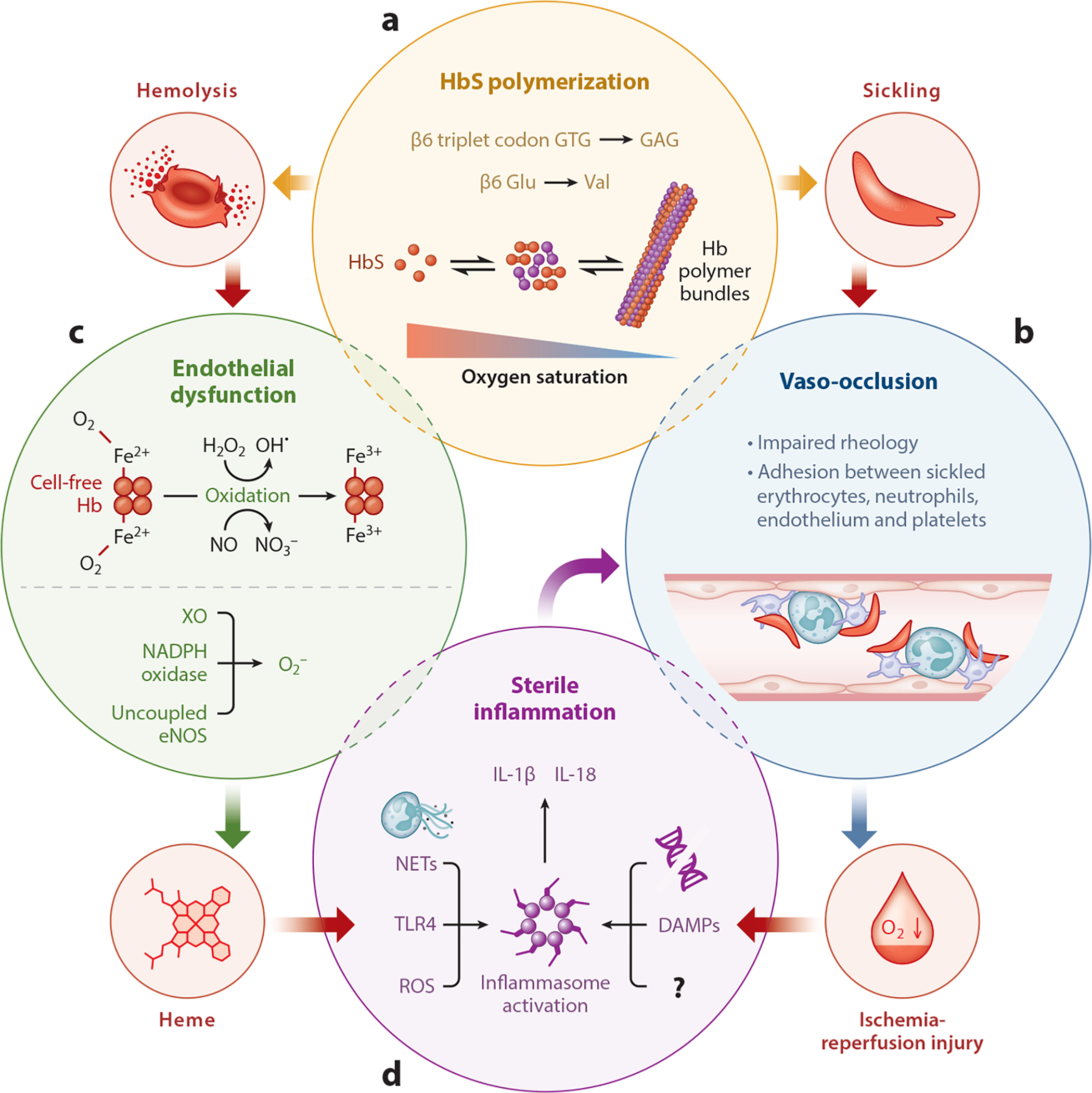 Sickle cell disease pathophysiology showing HbS polymerization, vaso-occlusion, and hemolysis