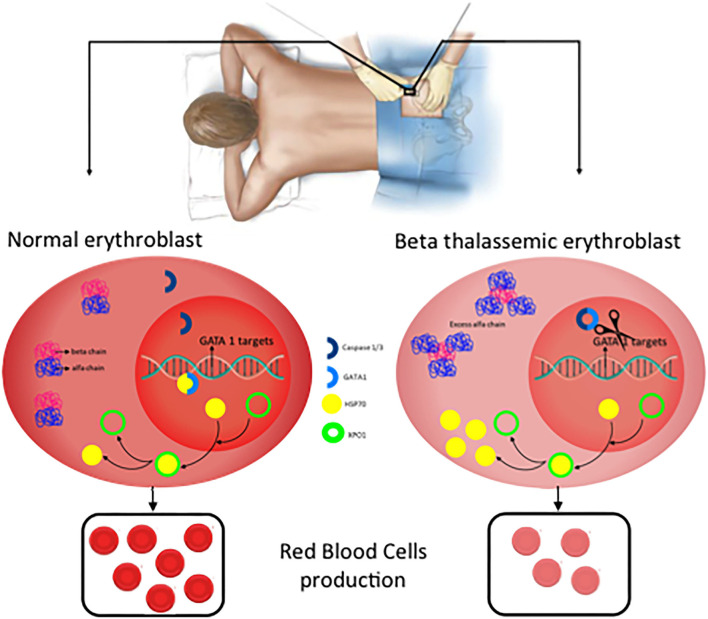 Novel therapeutic approaches for beta-thalassemia including gene therapy and luspatercept